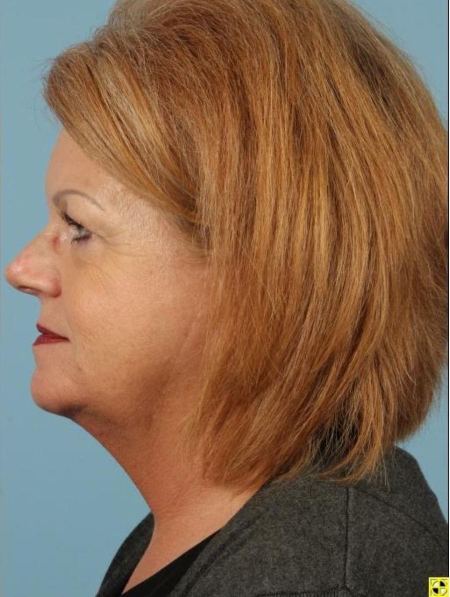 Kybella Patient Photo - Case 14362 - after view-1