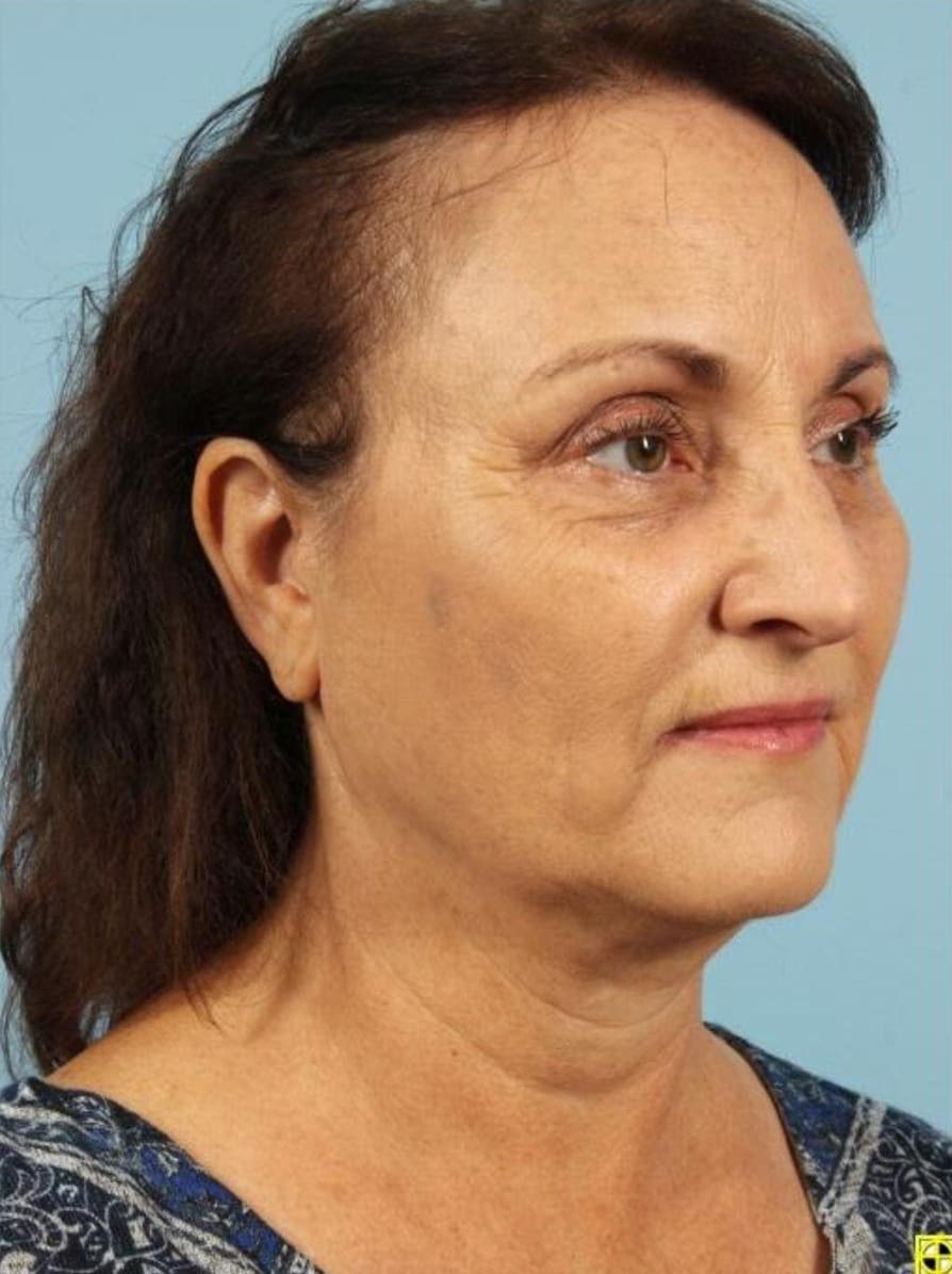 Kybella Patient Photo - Case 14369 - after view-4