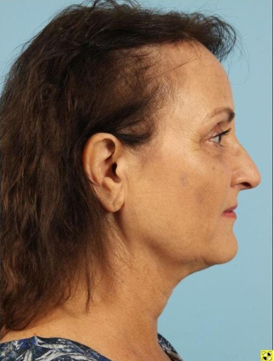 Kybella Patient Photo - Case 14369 - after view-2