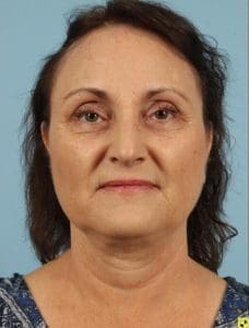 Kybella - Case 14369 - After