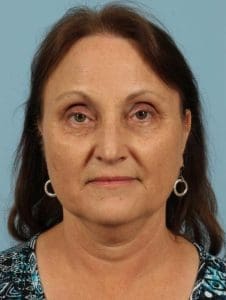 Kybella - Case 14369 - Before