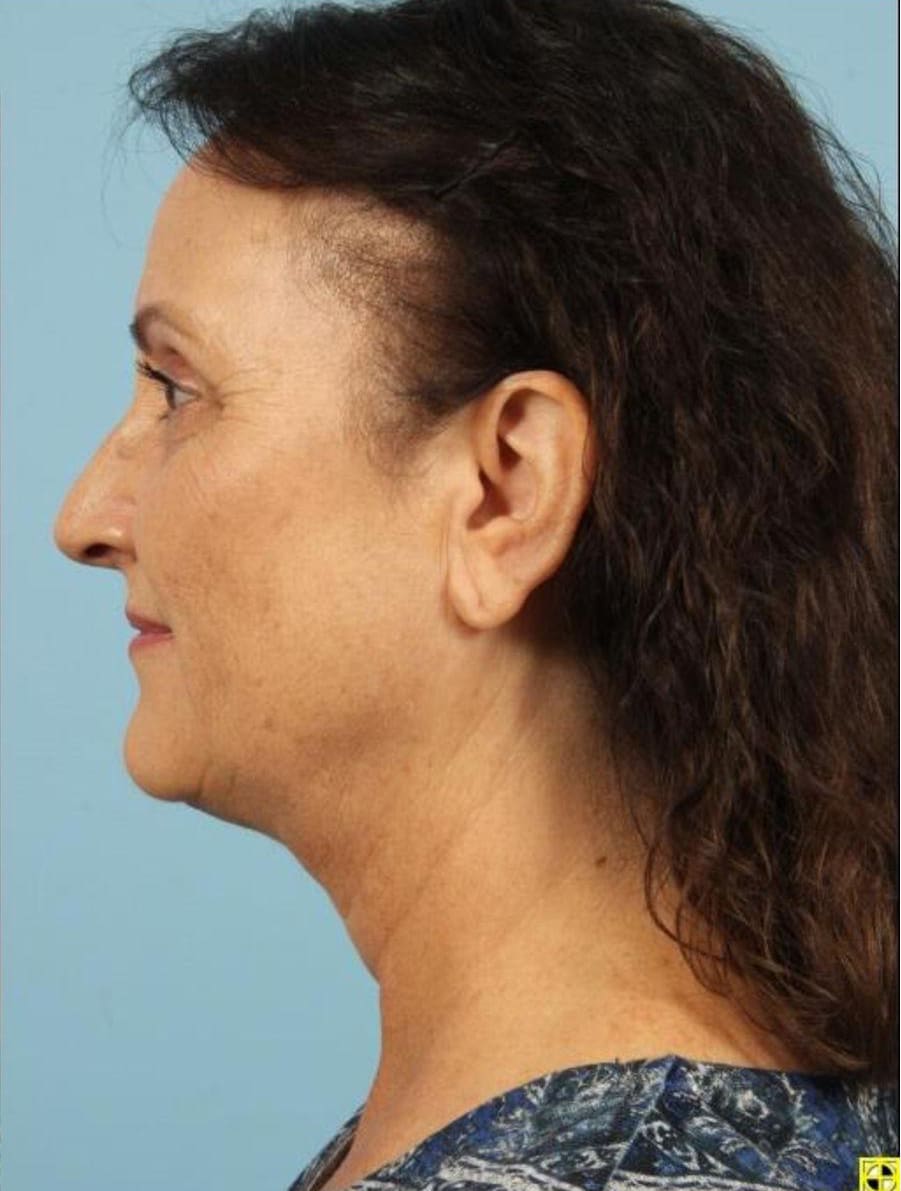 Kybella Patient Photo - Case 14369 - after view-1