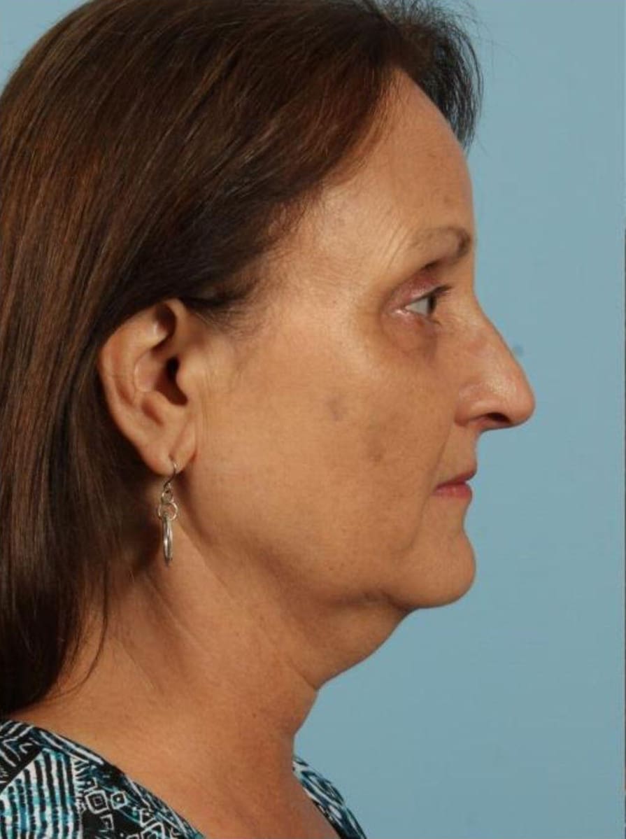 Kybella Patient Photo - Case 14369 - before view-2