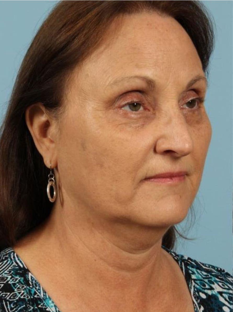 Kybella Patient Photo - Case 14369 - before view-4