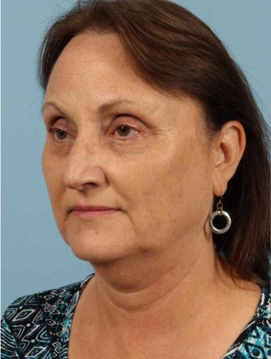 Kybella Patient Photo - Case 14369 - before view-3