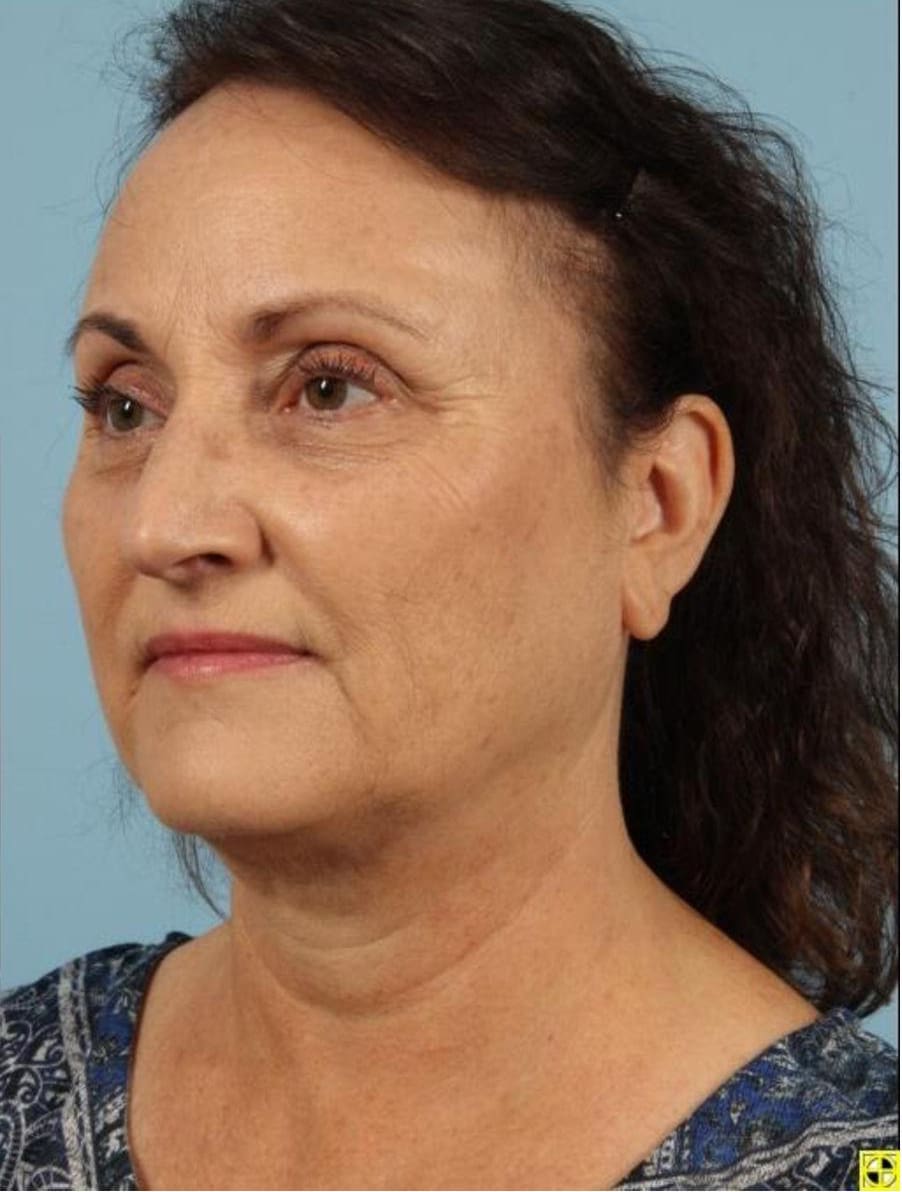 Kybella Patient Photo - Case 14369 - after view-3