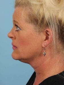 Kybella - Case 14381 - Before