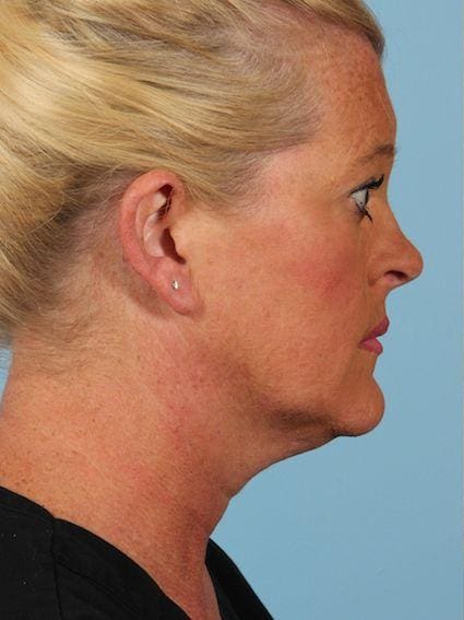Kybella Patient Photo - Case 14381 - before view-1