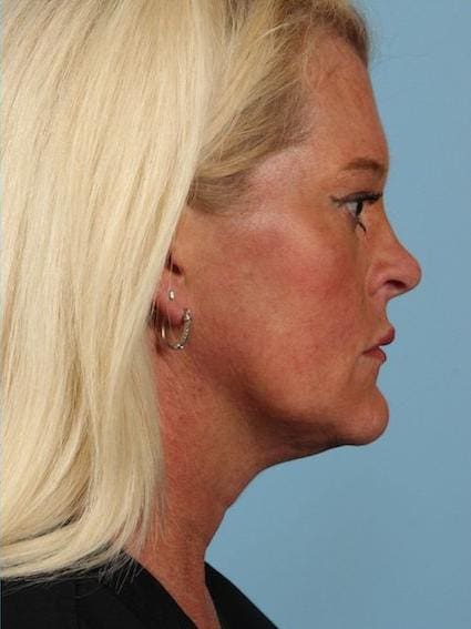 Kybella Patient Photo - Case 14381 - after view-1