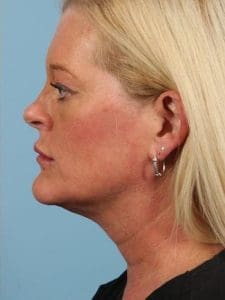 Kybella - Case 14381 - After
