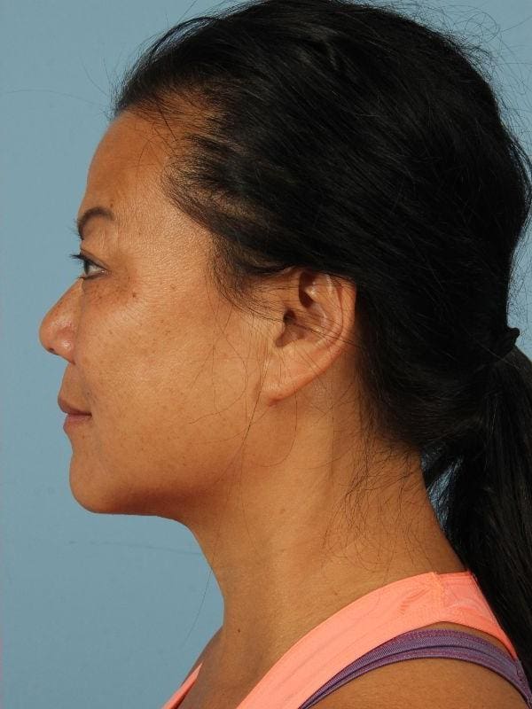 Kybella Patient Photo - Case 14391 - after view-1