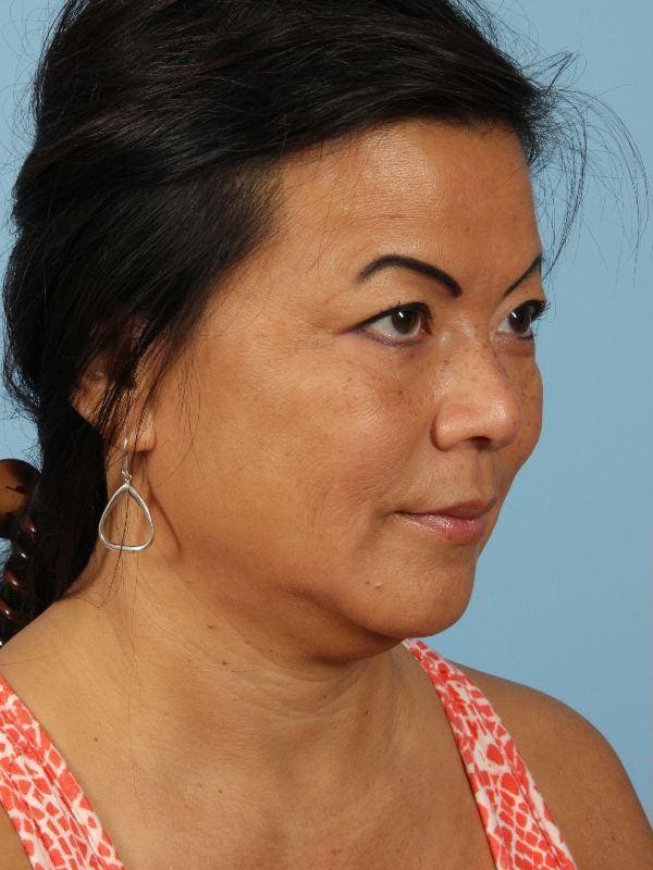 Kybella Patient Photo - Case 14391 - before view-4