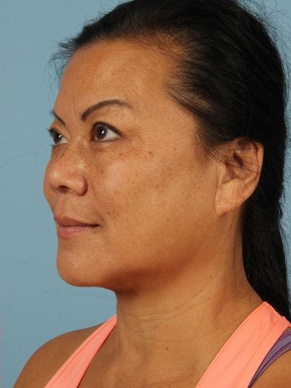 Kybella Patient Photo - Case 14391 - after view-3