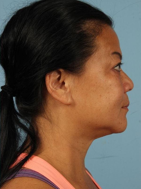 Kybella Patient Photo - Case 14391 - after view-2