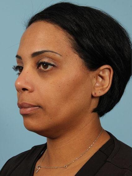 Kybella Patient Photo - Case 14412 - before view-1