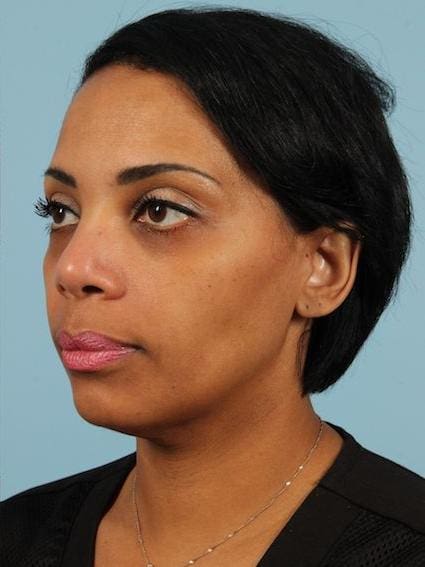 Kybella Patient Photo - Case 14412 - after view-1