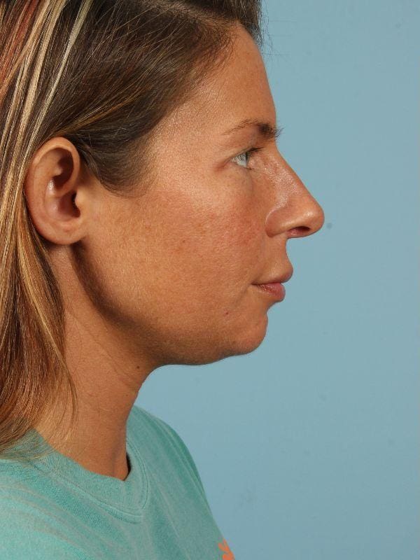 Kybella Patient Photo - Case 14418 - before view-1