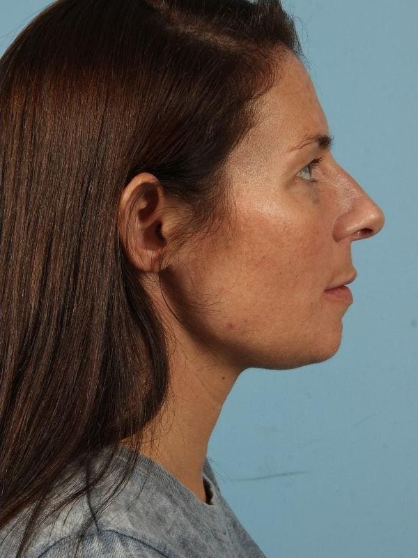 Kybella Patient Photo - Case 14418 - after view-1