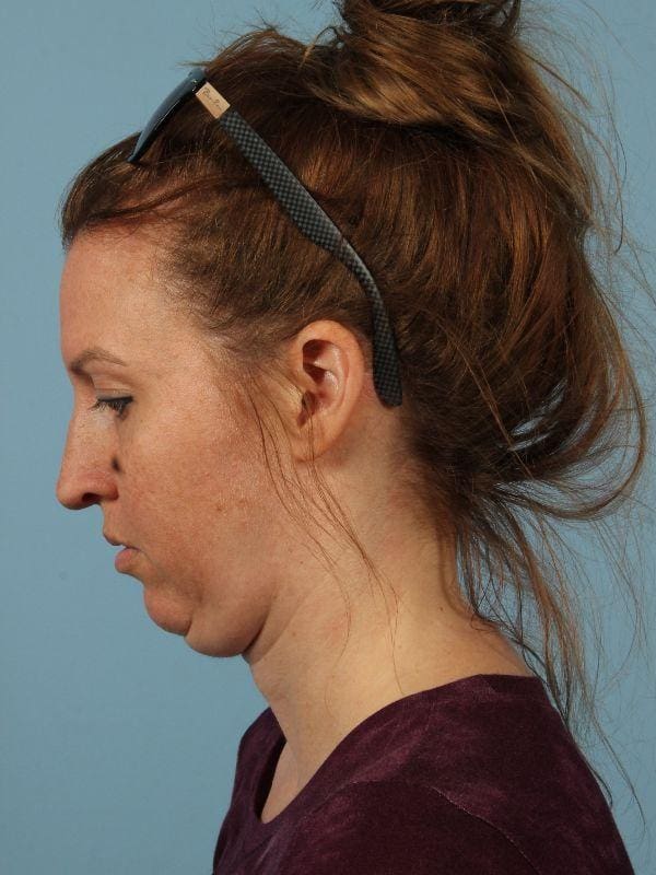 Kybella Patient Photo - Case 14424 - before view-3