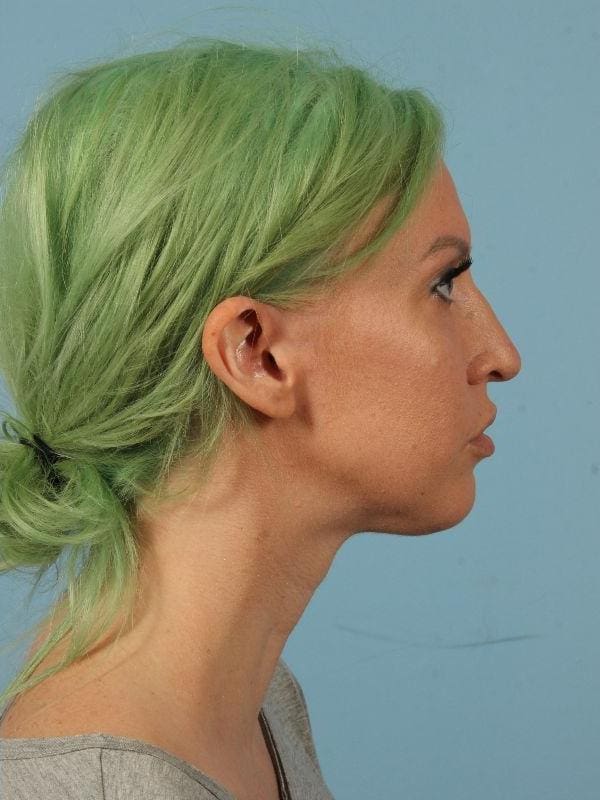 Kybella Patient Photo - Case 14424 - after view-2