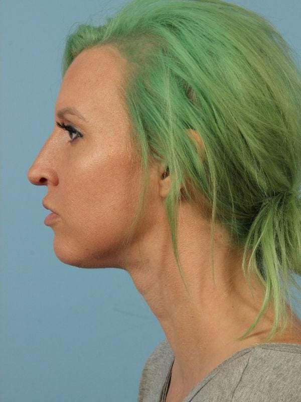 Kybella Patient Photo - Case 14424 - after view-1