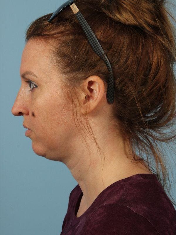 Kybella Patient Photo - Case 14424 - before view-1