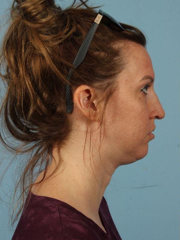 Kybella Patient Photo - Case 14424 - before view-2