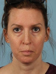 Case 14424 - Before
