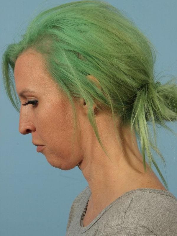 Kybella Patient Photo - Case 14424 - after view-3