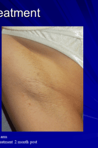 Laser Hair Reduction - Case 14443 - After