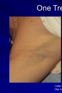 Laser Hair Reduction - Case 14443 - Before