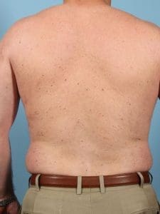Laser Hair Reduction - Case 14447 - After