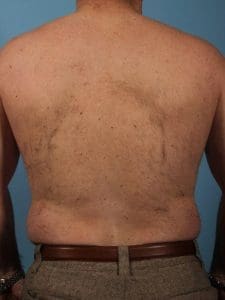 Laser Hair Reduction - Case 14447 - Before