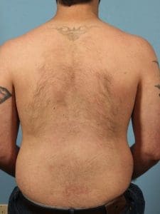 Laser Hair Reduction - Case 14452 - After