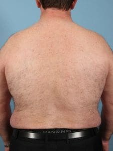 Laser Hair Reduction - Case 14456 - Before