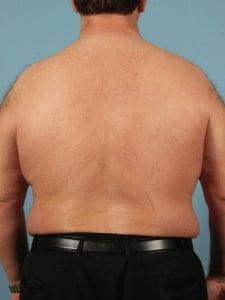 Laser Hair Reduction - Case 14456 - After
