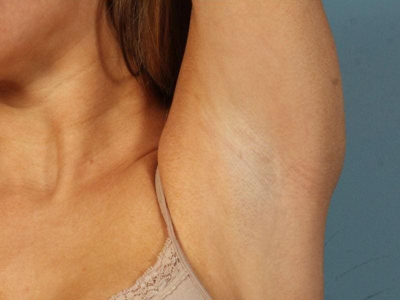Laser Hair Reduction Patient Photo - Case 14460 - after view-1