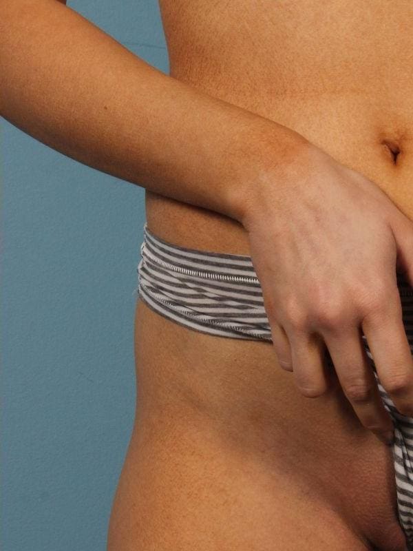 Laser Hair Reduction Patient Photo - Case 14460 - after view-2