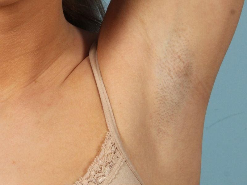 Laser Hair Reduction Patient Photo - Case 14460 - before view-1