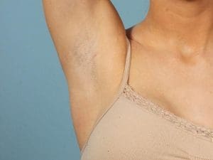 Laser Hair Reduction - Case 14460 - Before