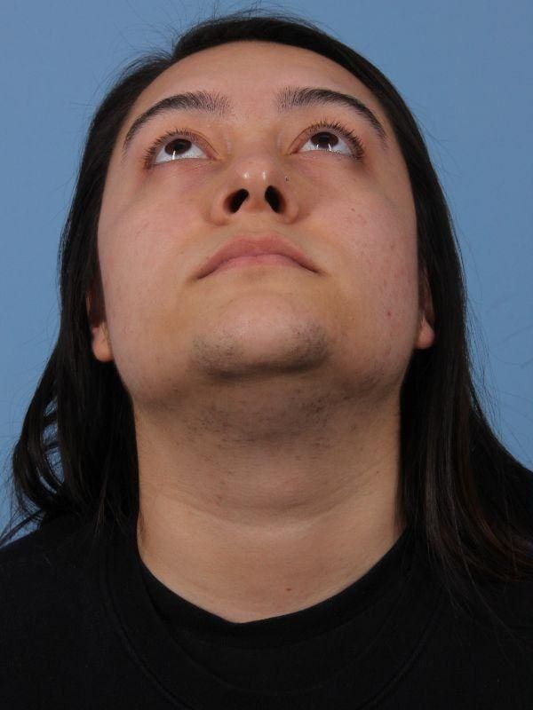 Laser Hair Reduction Patient Photo - Case 14471 - before view-1