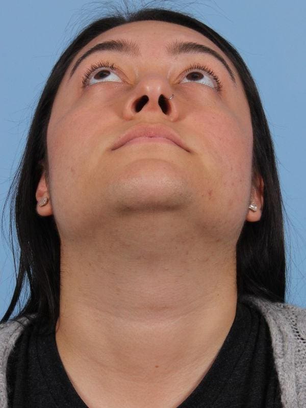 Laser Hair Reduction Patient Photo - Case 14471 - after view-1