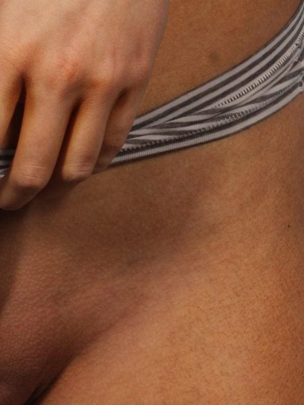 Laser Hair Reduction Patient Photo - Case 14477 - after view-1