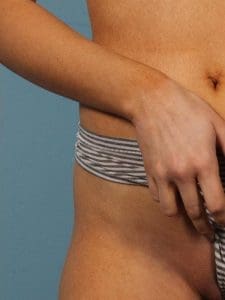 Laser Hair Reduction - Case 14477 - After