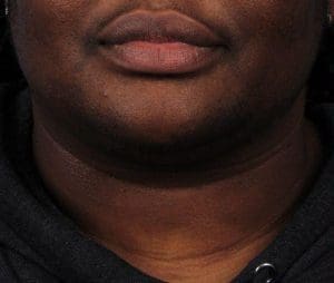 Laser Hair Reduction - Case 14483 - Before