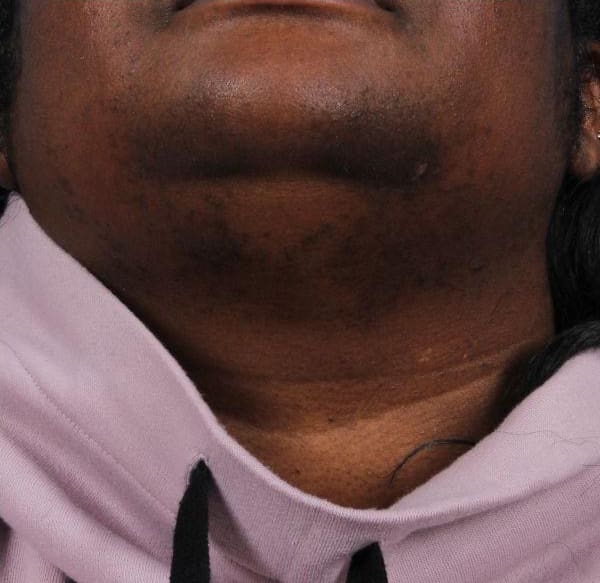 Laser Hair Reduction Patient Photo - Case 14483 - after view-3