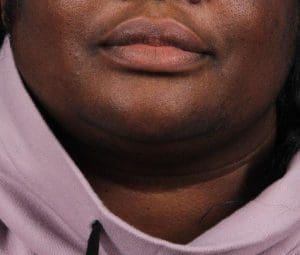 Laser Hair Reduction - Case 14483 - After