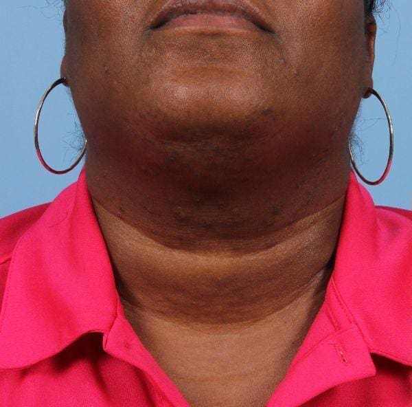 Laser Hair Reduction Patient Photo - Case 14493 - before view-1