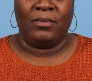 Laser Hair Reduction - Case 14493 - After