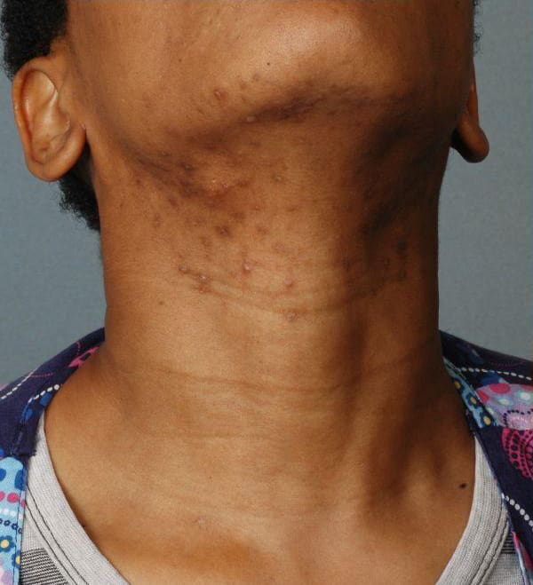 Laser Hair Reduction Patient Photo - Case 14499 - before view-